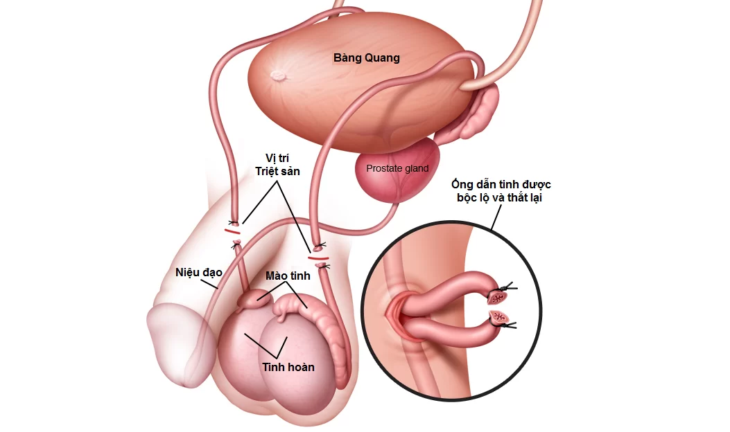 Thắt ống dẫn tinh là gì? Có gây yếu sinh lý không? Có nối lại được không?